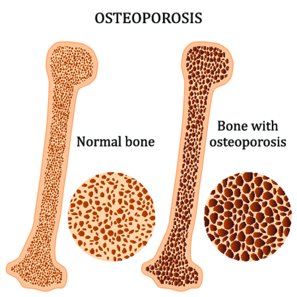 Як лікувати остеопороз кісток народними засобами?