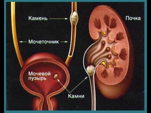 Як лікувати пієлонефрит за допомогою народних засобів