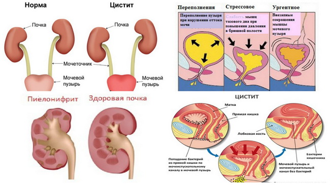 Як лікувати пієлонефрит за допомогою народних засобів