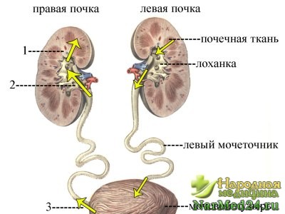 Як лікувати пієлонефрит за допомогою народних засобів