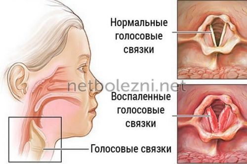 Як лікувати першащий кашель