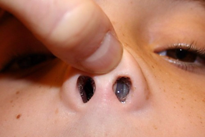 Як лікувати поліпи в носі у дитини