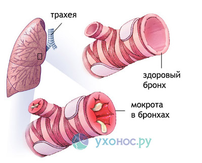 Як лікувати сильний гнійний кашель ? гнійне мокротиння при кашлі ? Лікування хвороб