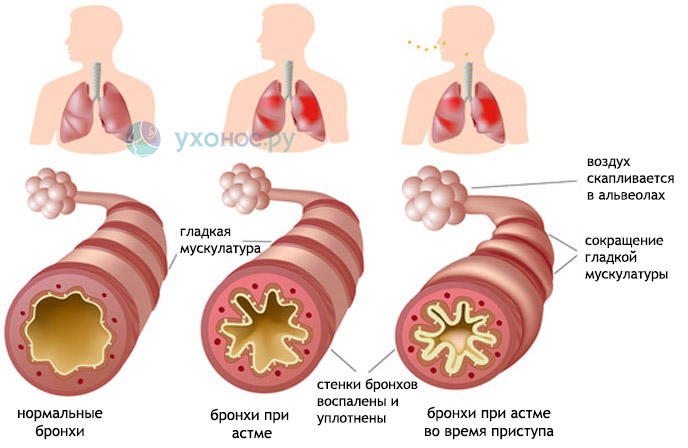 Як лікувати сильний гнійний кашель ? гнійне мокротиння при кашлі ? Лікування хвороб