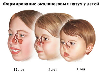 Як лікувати синусит: медикаменти, операції і домашня терапія. Відео — Синусит