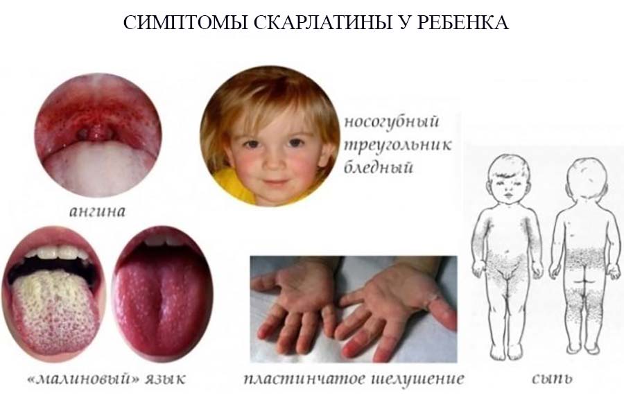 Як лікувати скарлатину у дітей