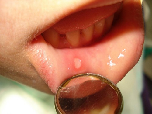 Як лікувати стоматит у роті у дітей народними засобами