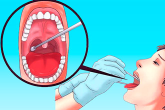 Як лікувати стрептокок в горлі – як його вивести і позбутися 2019
