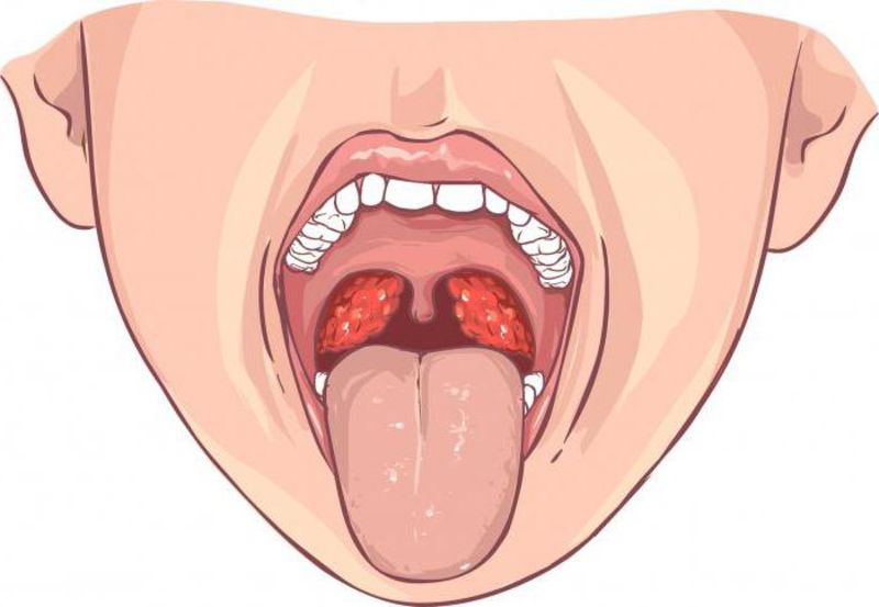 Як лікувати стрептокок в горлі – як його вивести і позбутися 2019