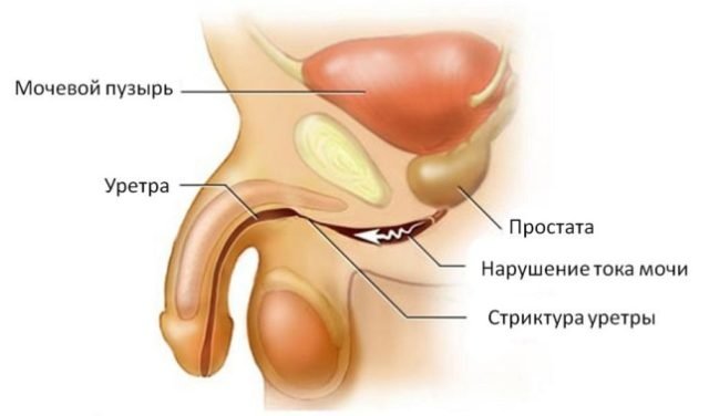 Як лікувати уретрит в домашніх умовах у чоловіків і жінок