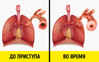 Як лікувати закладеність у грудях та кашель