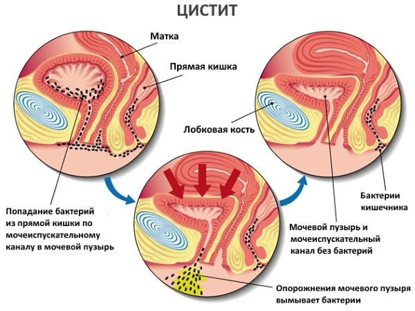 Як лікувати запалений сечовий міхур