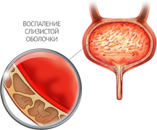 Як лікувати запалений сечовий міхур