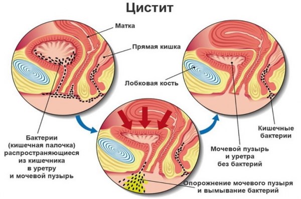 Як лікувати запалений сечовий міхур