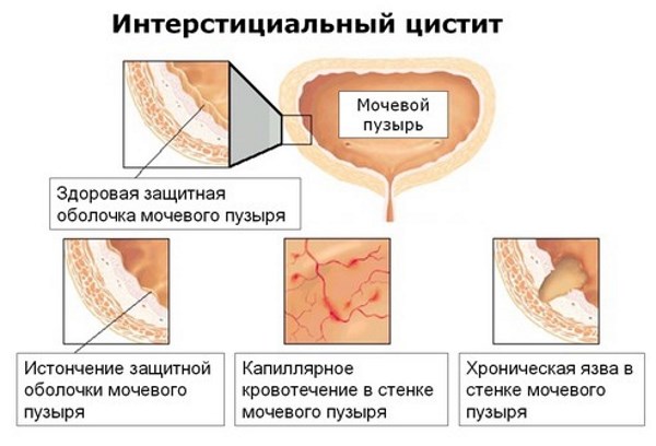 Як лікувати запалений сечовий міхур