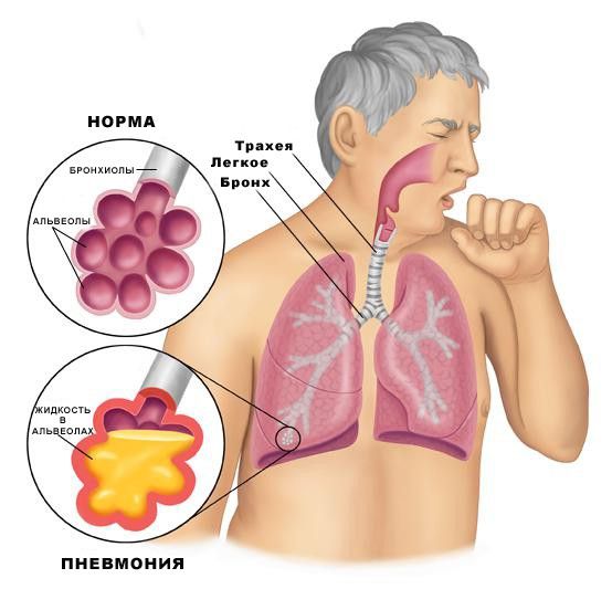 Як лікувати запалення легенів у домашніх умовах
