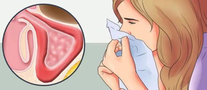 Як лікувати запалення слизової оболонки носа