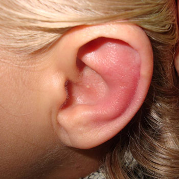 Як лікувати запалення вуха в домашніх умовах