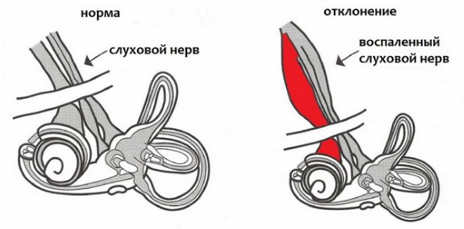 Як лікують кохлеарний неврит слухового нерва