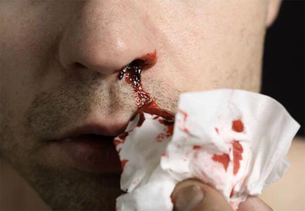 Як можна швидко і ефективно зупинити носову кровотечу