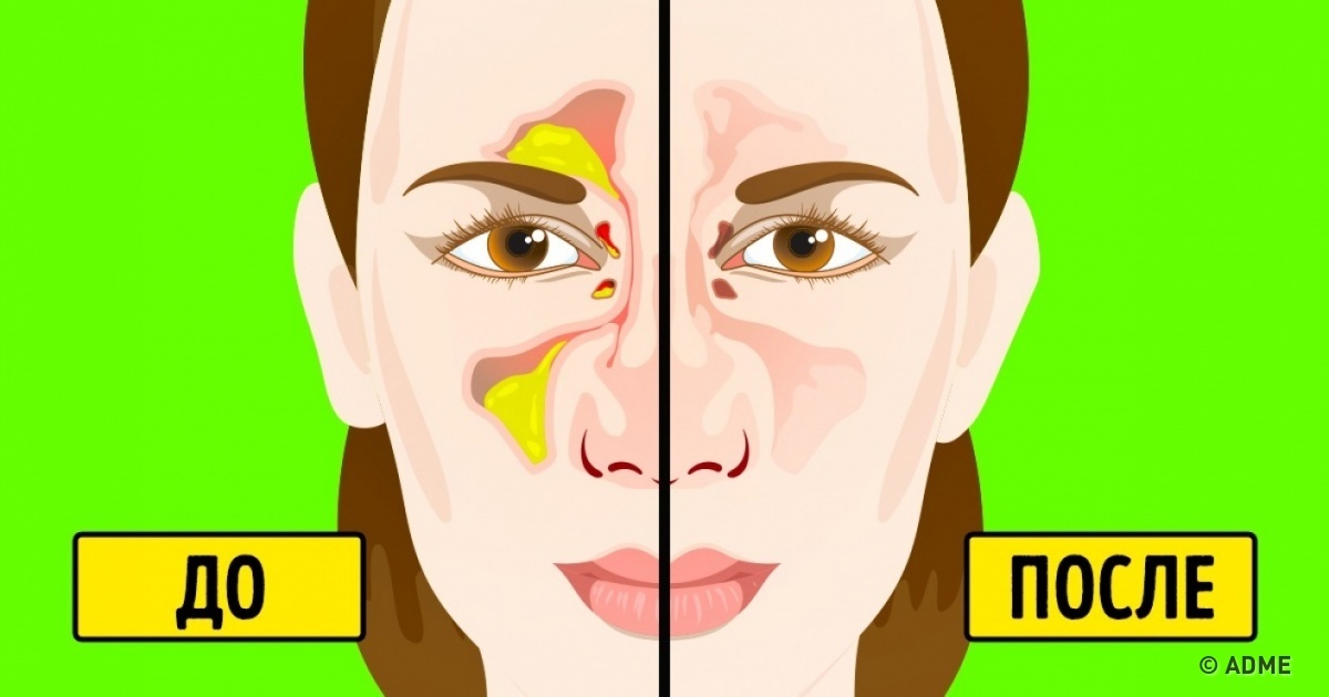 Як можна швидко позбутися від нежиті і закладеності носа?