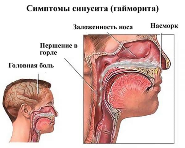 Як можна вилікувати гайморит будинку