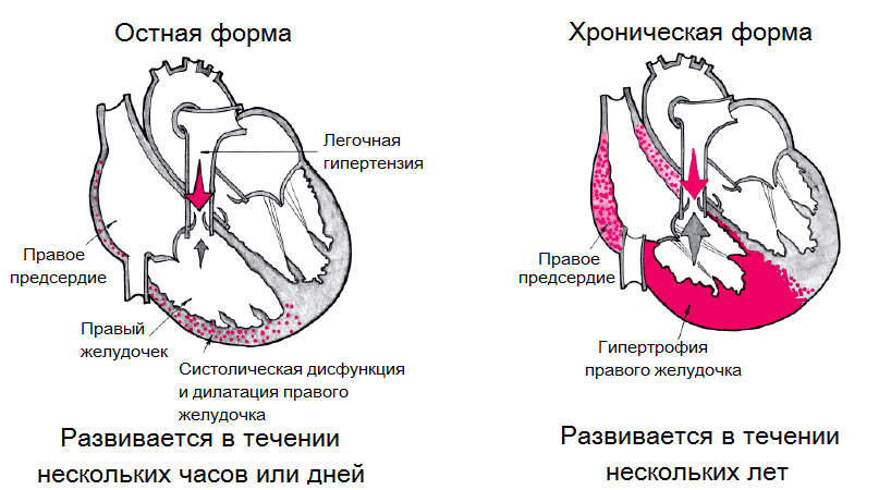 Як назавжди позбутися бронхіальної астми