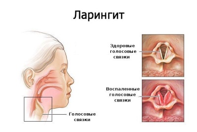 Як орошувати горло Мірамістином