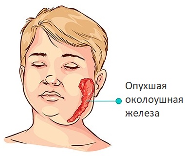 Які перші ознаки паротиту у дітей і дорослих