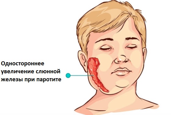 Які перші ознаки паротиту у дітей і дорослих