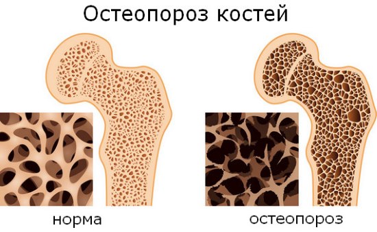 Як починається клімакс у жінок перші ознаки та симптоми