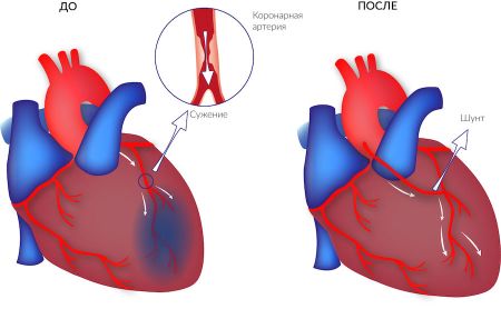 Як почистити судини від холестерину медикаментами