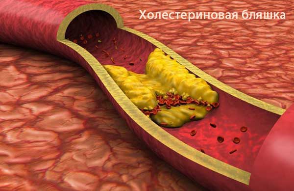 Як почистити судини від холестерину медикаментами