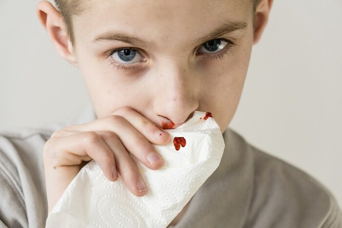 Як правильно зупинити кров з носа у дитини у дорослого