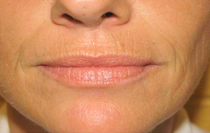 Як прибрати зморшки над верхньою губою: салонні процедури і народні засоби