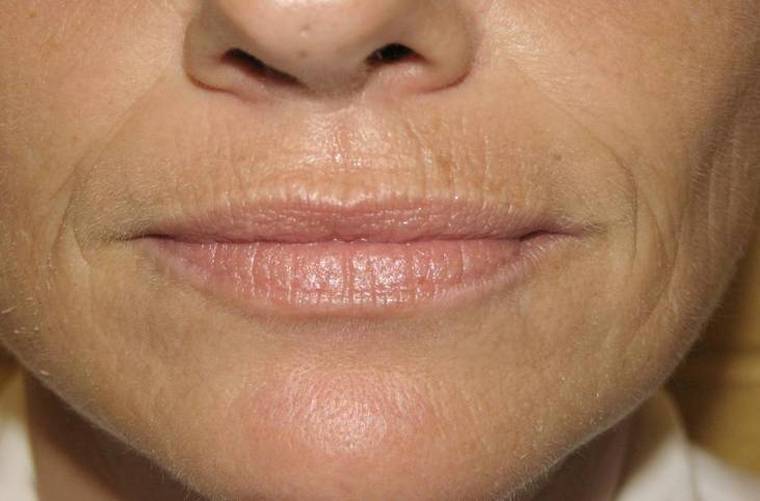Як прибрати зморшки над верхньою губою: салонні процедури і народні засоби