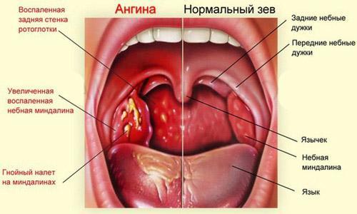 Які причини болю в горлі при ковтанні