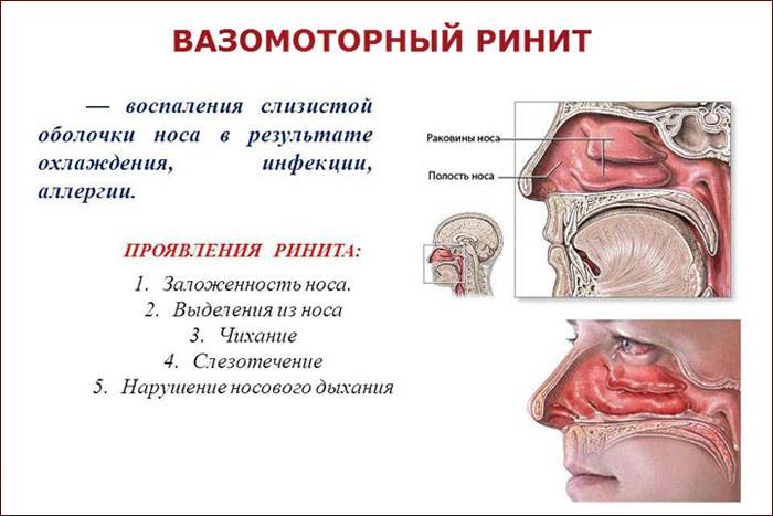 Як пробити ніс без крапель, що робити, якщо ніс не дихає, як змусити ніс дихати без крапель