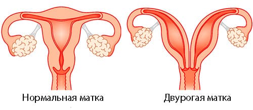 Як проходить вагітність при дворогій матці