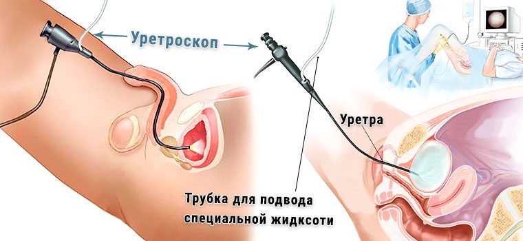 Як проводиться масаж і бужування уретри які при цьому застосовуються інструменти