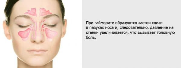 Як проявляється гайморит симптоми і хронічні прояви