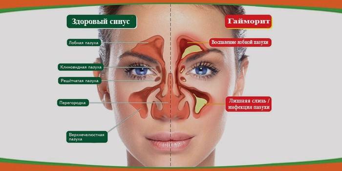 Як проявляється гайморит у дорослих і дітей