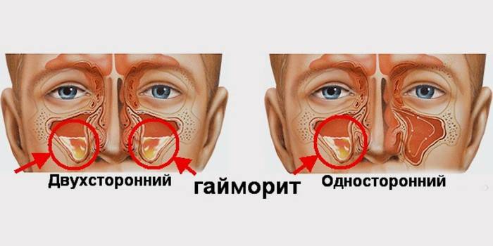 Як проявляється гайморит у дорослих і дітей