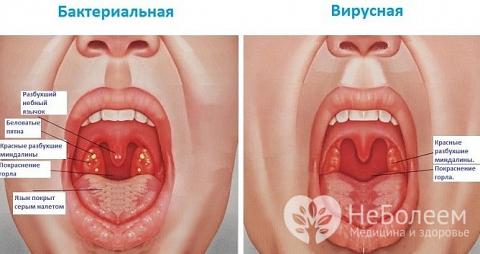 Як проявляється і лікується хронічний фарингіт