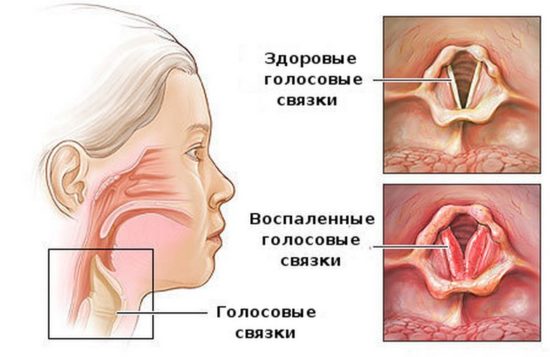 Як проявляється ларинготрахеїт у дорослих і чим лікувати недугу? Лікування ларинготрахеїту у дорослих препарати.