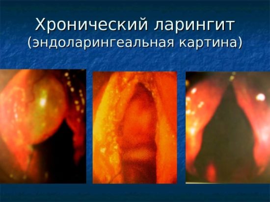 Як проявляється ларинготрахеїт у дорослих і чим лікувати недугу? Лікування ларинготрахеїту у дорослих препарати.