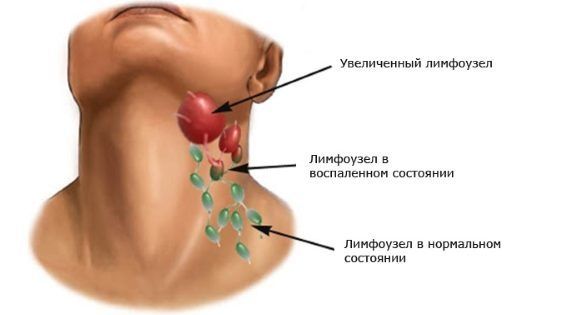 Як робити компрес з капусти при кашлі