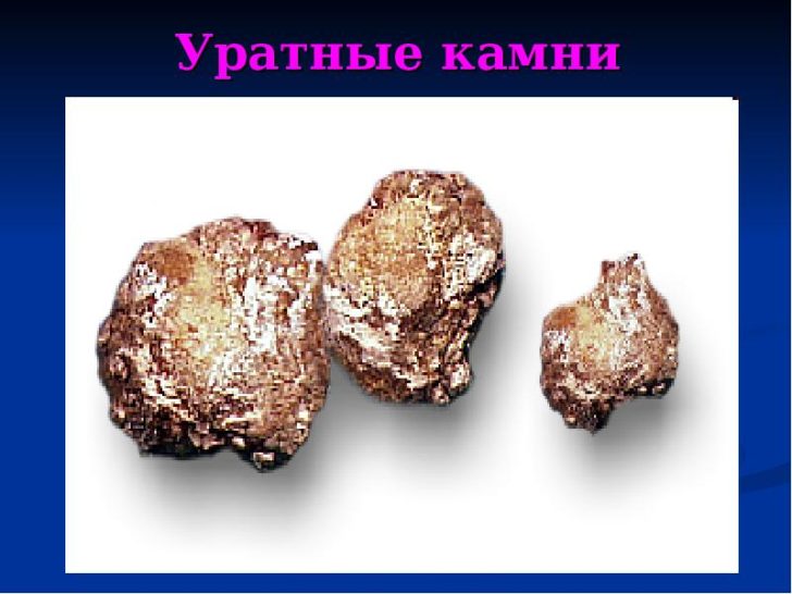 Як розчинити камені в нирках препарати та народні засоби