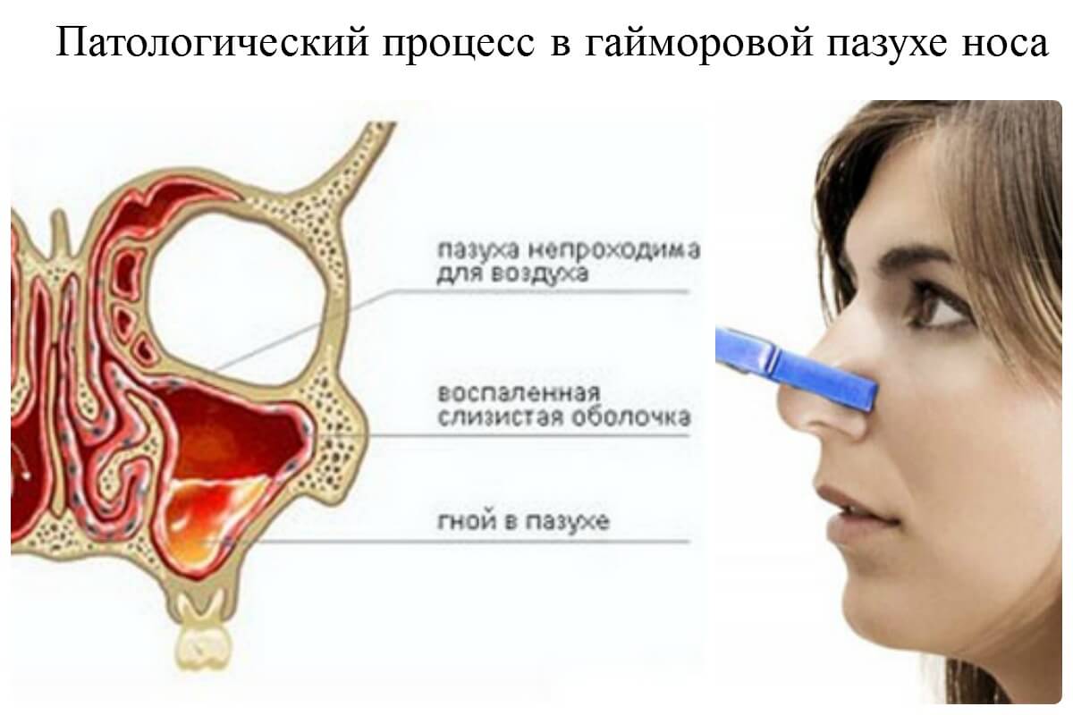 Як розпізнати і вилікувати хронічний гайморит