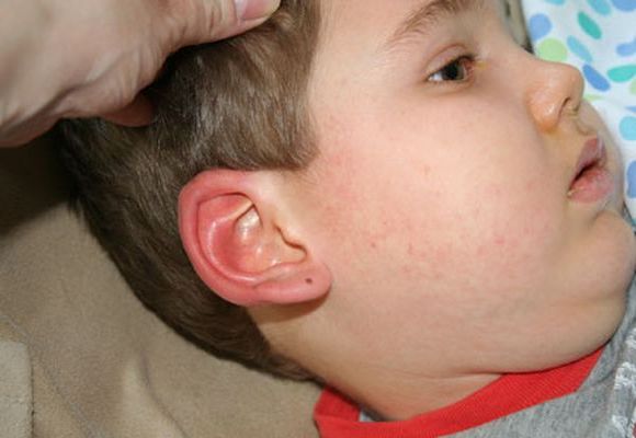 Як розпізнати і вилікувати стафілокок у вухах